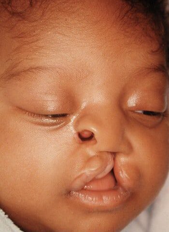 Before Image: Facial Cleft - right-front-oblique