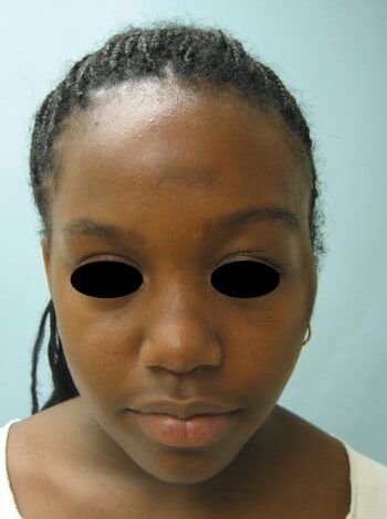After Image: Neurofibromatosis Case Study 23 – Surgical Expertise - front