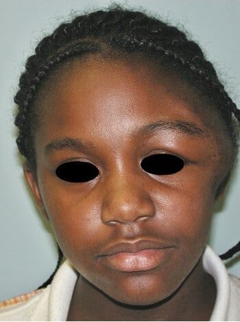 Before Image: Neurofibromatosis Case Study 23 – Surgical Expertise - front