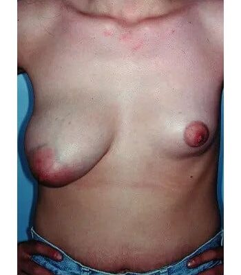 Before Image: Asymmetric Breasts - front