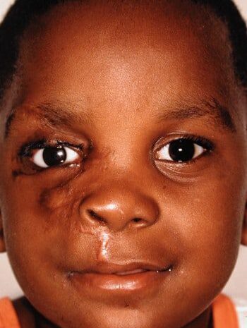 After Image: Facial Cleft - front