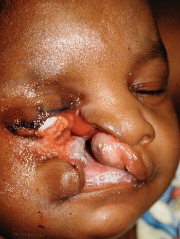 Before Image: Facial Cleft - front