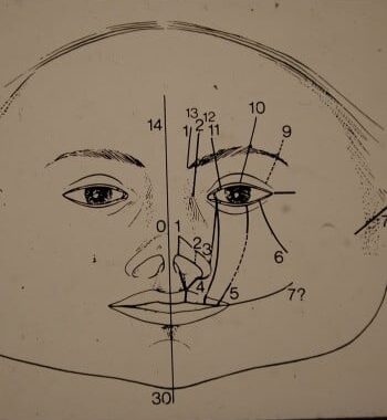 After Image: Facial Cleft - front