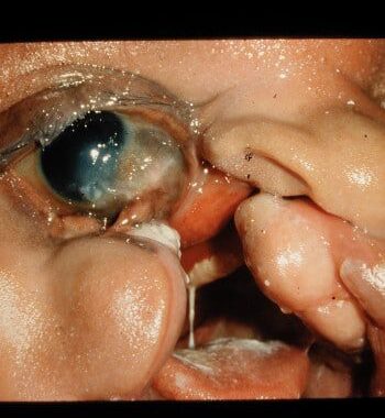 Before Image: Facial Cleft - front
