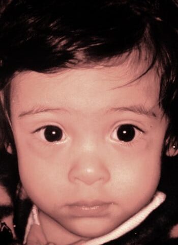 After Image: Craniosynostosis - front