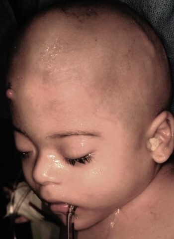 Before Image: Craniosynostosis - front