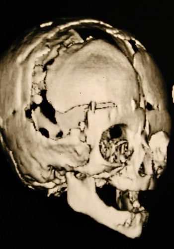 After Image: Craniosynostosis - right-front-oblique
