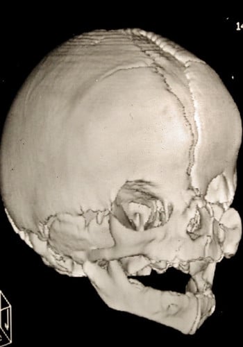 Before Image: Craniosynostosis - right-front-oblique
