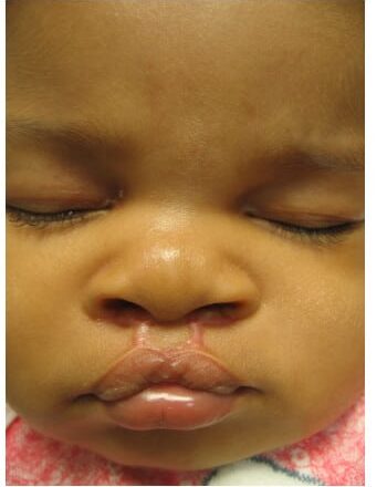 After Image: Cleft Lip - front