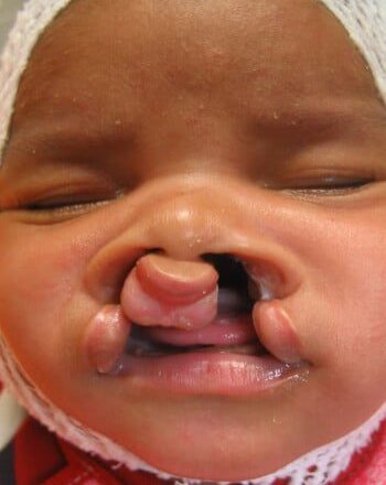 Before Image: Cleft Lip - front