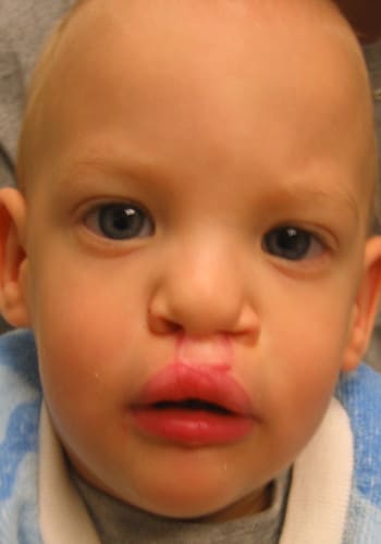 After Image: Cleft Lip - right-front-oblique