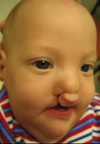 Before Image: Cleft Lip - right-front-oblique