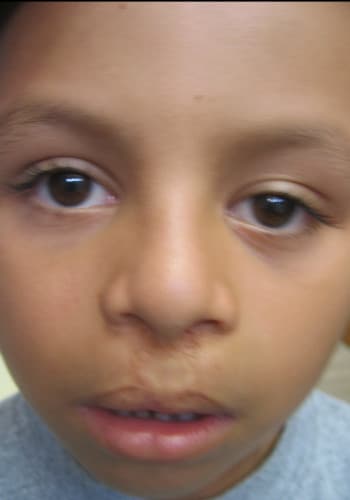 After Image: Cleft Lip - front