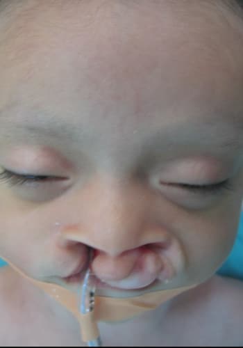 Before Image: Cleft Lip - front