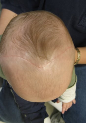 After Image: Craniosynostosis - front