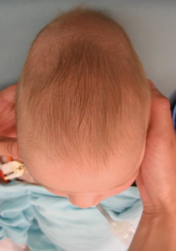 Before Image: Craniosynostosis - front