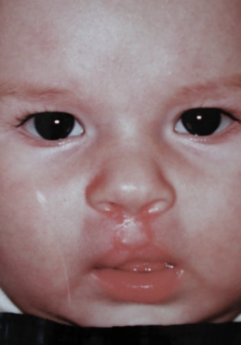 After Image: Cleft Lip - front