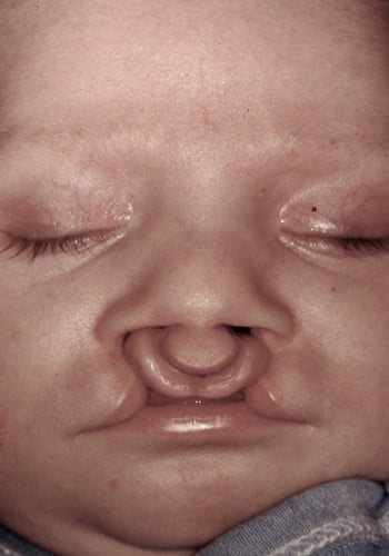 Before Image: Cleft Lip - front