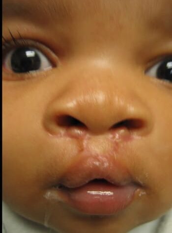 After Image: Cleft Lip - front