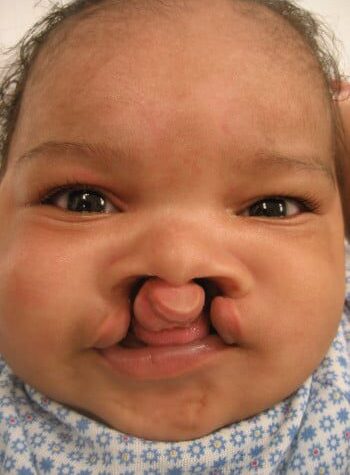 Before Image: Cleft Lip - front