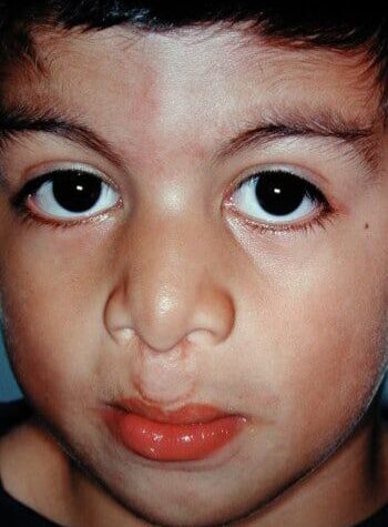 After Image: Cleft Lip - front