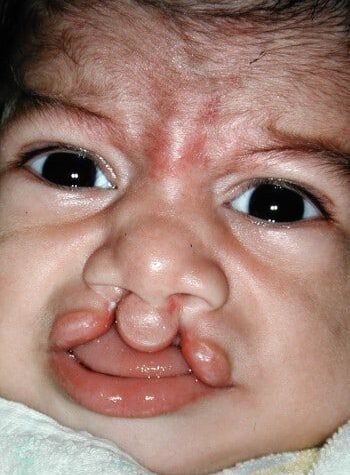 Before Image: Cleft Lip - front