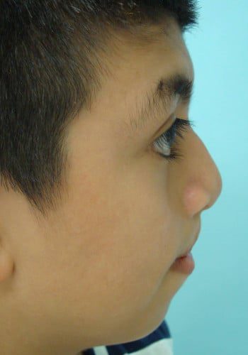 After Image: Cleft Lip - right-side