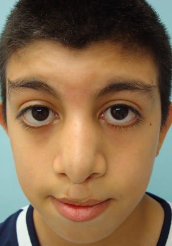 Before Image: Cleft Lip - right-side