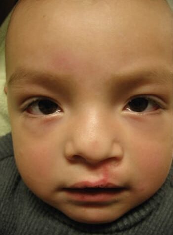 After Image: Cleft Lip - front