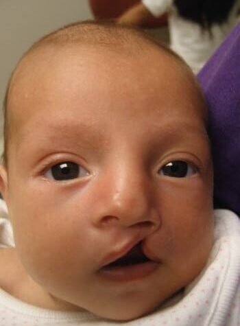 Before Image: Cleft Lip - front
