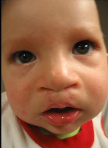After Image: Cleft Lip - right-front-oblique