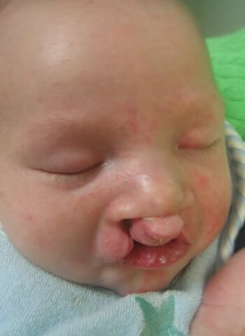 Before Image: Cleft Lip - right-front-oblique