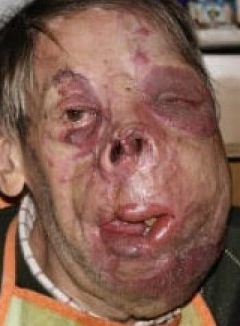 After Image: Venous Malformation - front