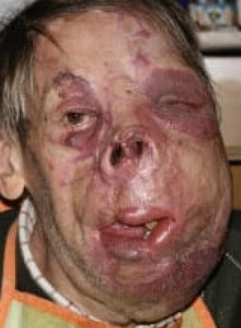 After Image: Venous Malformation - front