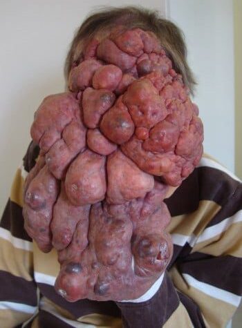 Before Image: Venous Malformation - front