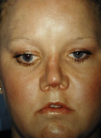 After Image: Nasal Reconstruction - front
