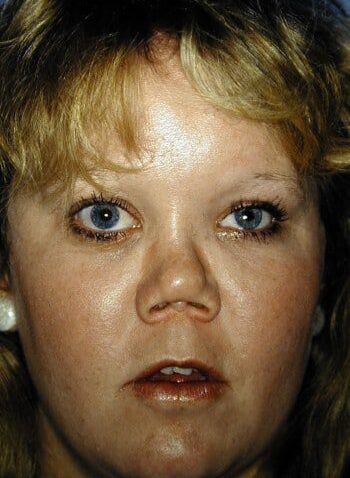Before Image: Nasal Reconstruction - front
