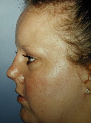 After Image: Nasal Reconstruction - left-side
