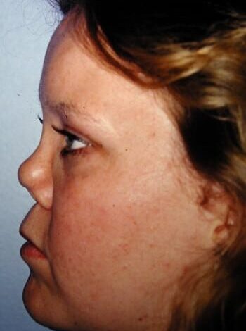 Before Image: Nasal Reconstruction - left-side