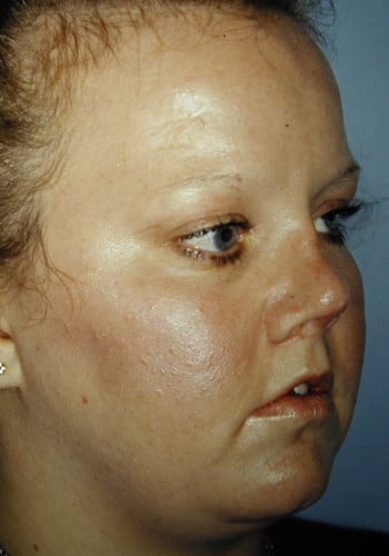After Image: Nasal Reconstruction - right-front-oblique