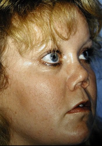 Before Image: Nasal Reconstruction - right-front-oblique