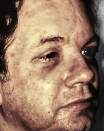 After Image: Facial Fracture - front