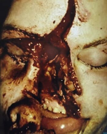 Before Image: Facial Fracture - front