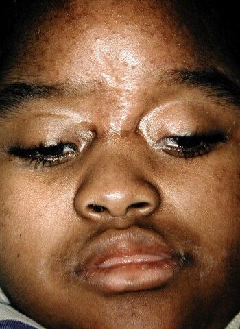 After Image: Encephalocele - front
