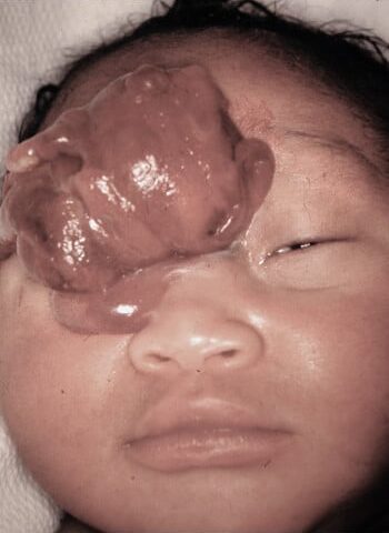 Before Image: Encephalocele - front