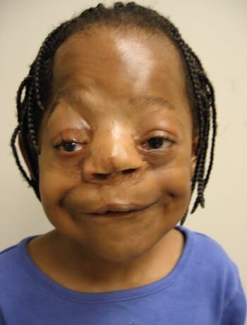 After Image: Facial Cleft - front