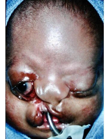 Before Image: Facial Cleft - front