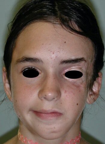 After Image: Craniofacial Tumor (Juvenile Fibromatosis) - front