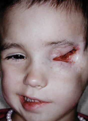 Before Image: Craniofacial Tumor (Juvenile Fibromatosis) - front