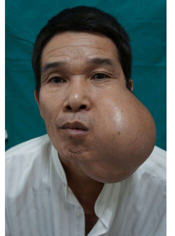 Before Image: Mandible Reconstruction - front